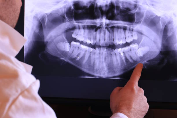 Best Emergency Wisdom Tooth Extraction in Valdosta, GA